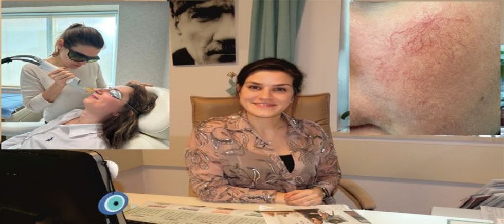 Kılcal Damar Görüntüsü Lazerle Gideriliyor